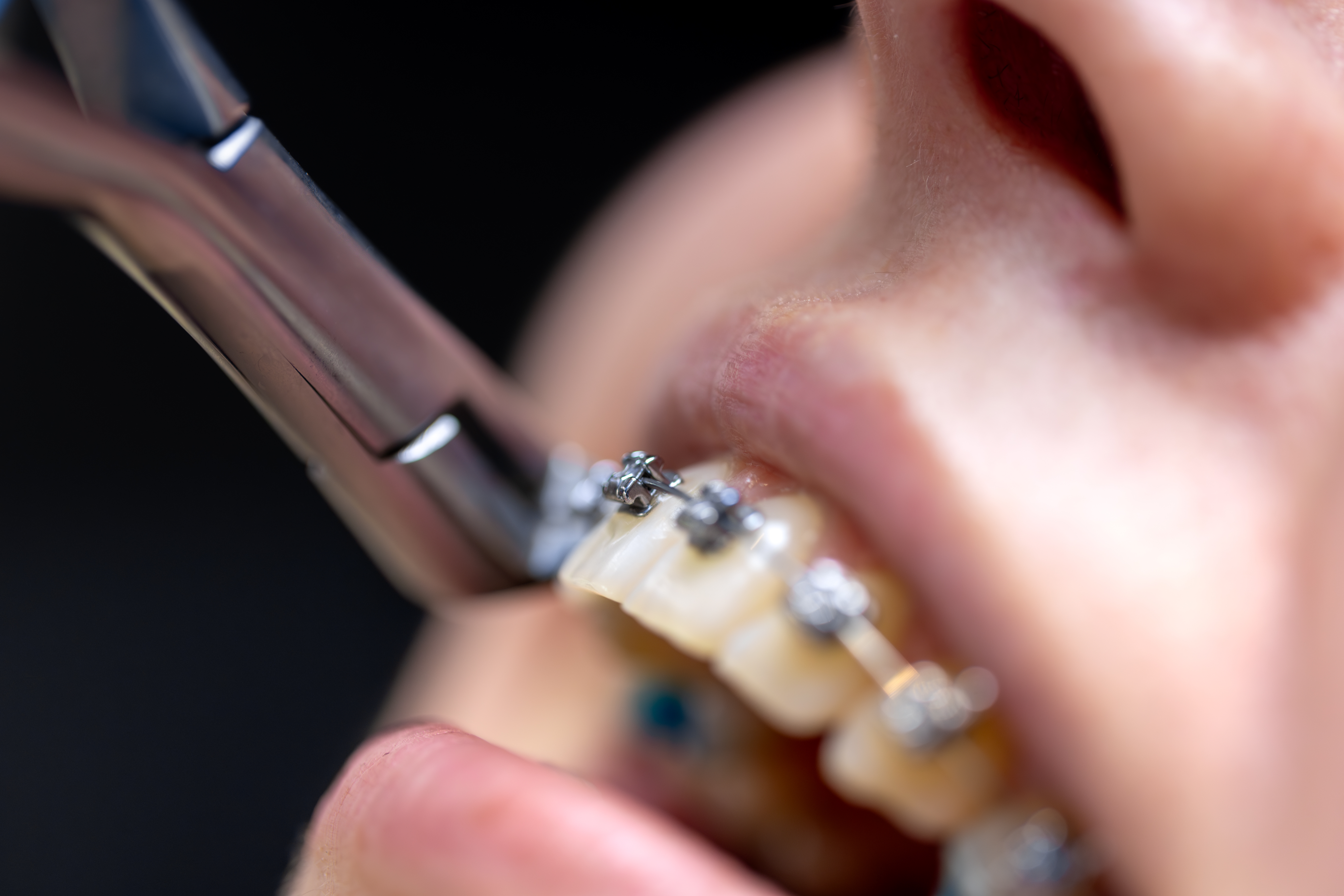 Ceramic inlay being placed